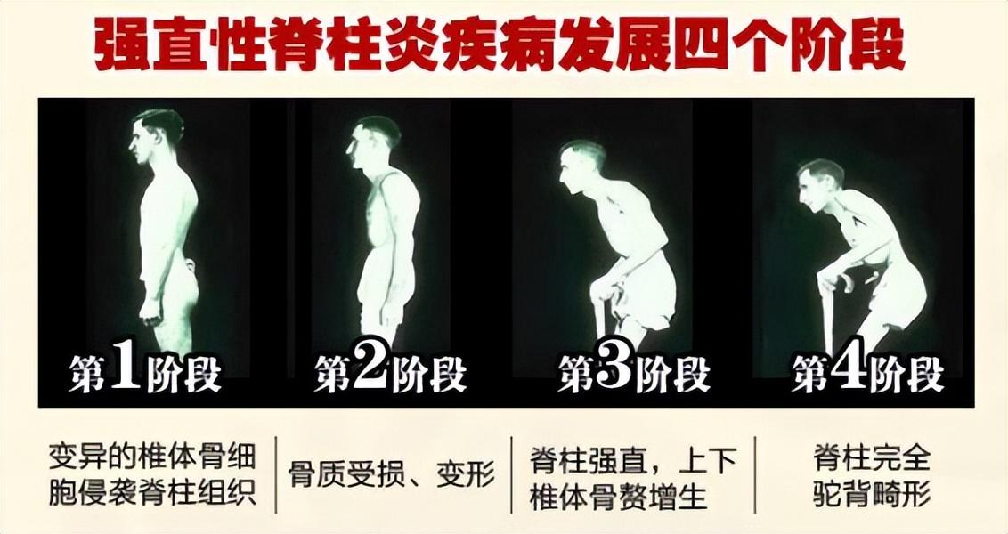 (李宇春身价多少亿)38岁的李宇春患病,为什么身价上亿也治不好?网友:不死的癌症 第5张 (李宇春身价多少亿)38岁的李宇春患病,为什么身价上亿也治不好?网友:不死的癌症 第5张