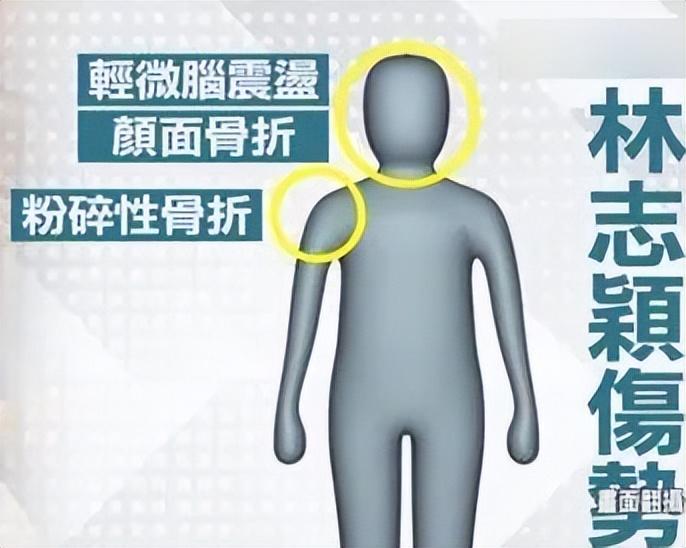 (一百万台币等于多少人民币)陈若仪称林志颖已清醒,赠送恩人每人100万台币,或将进行3D整骨 第9张 (一百万台币等于多少人民币)陈若仪称林志颖已清醒,赠送恩人每人100万台币,或将进行3D整骨 第9张