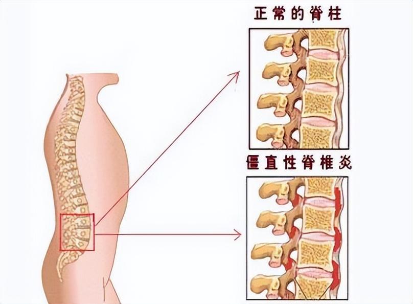 (李宇春身价多少亿)38岁的李宇春患病,为什么身价上亿也治不好?网友:不死的癌症 第4张 (李宇春身价多少亿)38岁的李宇春患病,为什么身价上亿也治不好?网友:不死的癌症 第4张